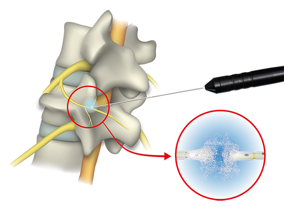 Illustration: cryoprobe at target nerve of facet joint Illustration: cryoprobe at target nerve of facet joint